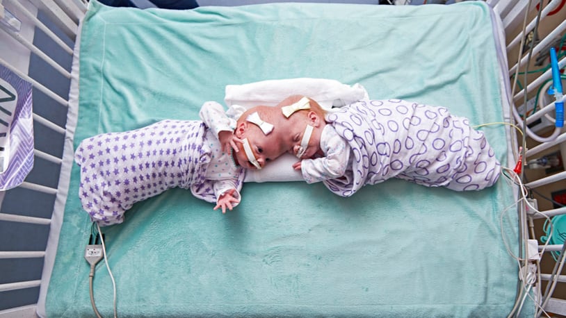 This September 2016 photo provided by the Children's Hospital of Philadelphia shows conjoined twin girls Abby Delaney, right, and Erin at the Children's Hospital of Philadelphia in Philadelphia. Hospital officials say surgeons successfully separated the 10-month-old twins June 6, 2017, during an 11-hour surgery. (Ed Cunicelli/Children's Hospital of Philadelphia via AP)
