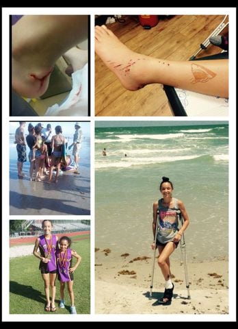 Photos: Seminole County girl bitten by shark