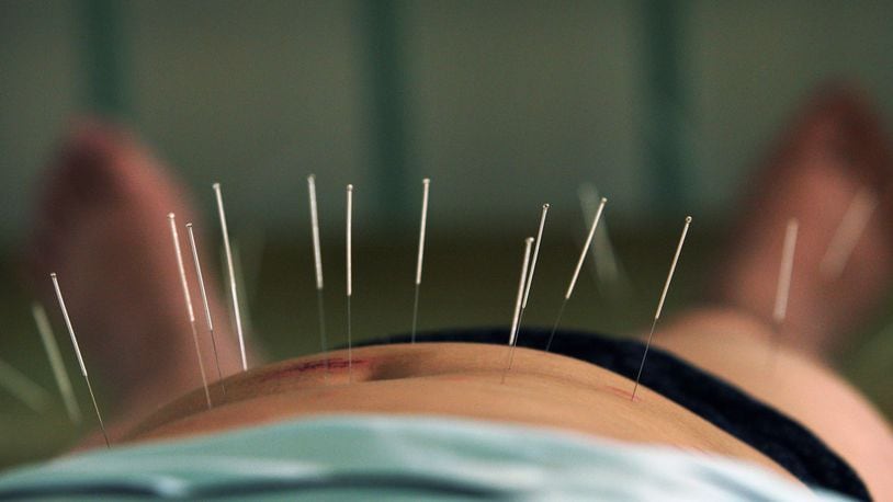 Acupuncture is one of the alternatives a new study recommends for treating lower back pain.