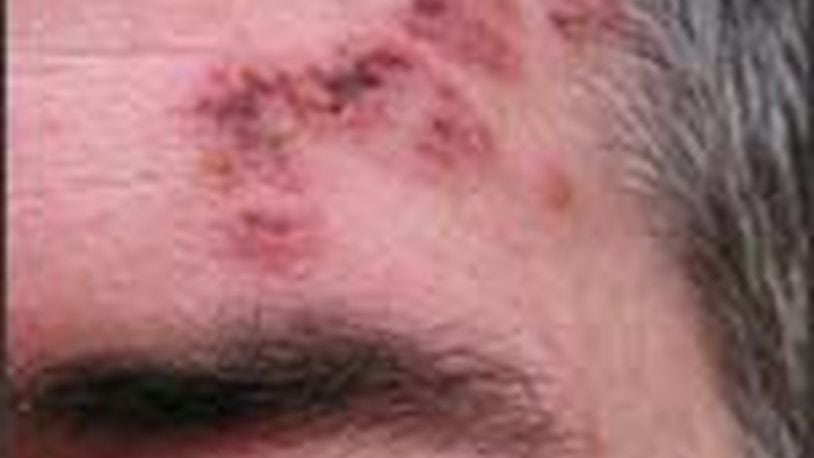 Shingles is a painful rash. Centers for Disease Control and Prevention