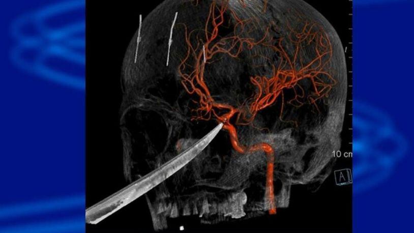 This 3D computer graphic model made from X-ray imagery shows how a tip of the knife stopped against the carotid artery of 15-year-old Eli Gregg.