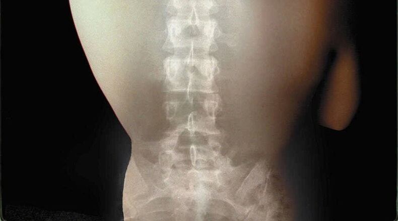The X-ray of a spine super-imposed on a woman’s back illustrates the importance of monitoring and treatment of osteoporosis, a weakening of the bones that affects 25 million Americans. FILE