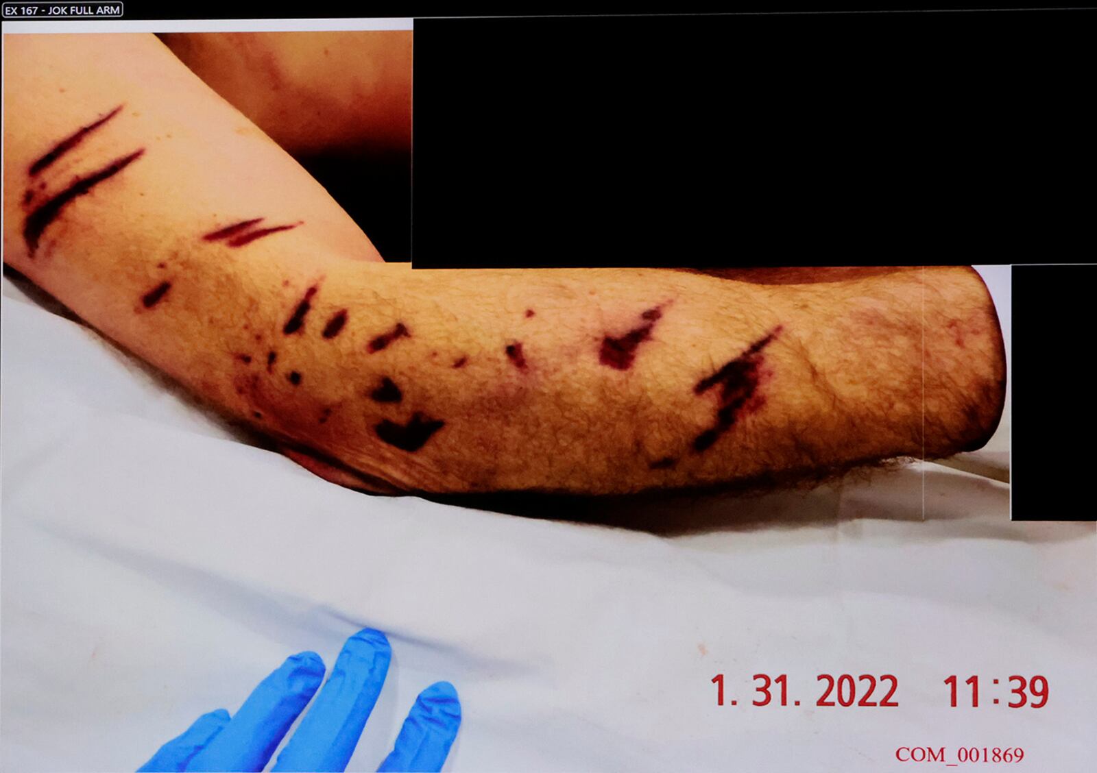 A photograph of John O'Keefe's right arm is republished during the murder retrial of Karen Read in Norfolk Superior Court, Monday, June 2, 2025, in Dedham, Mass. (Pat Greenhouse/The Boston Globe via AP, Pool)