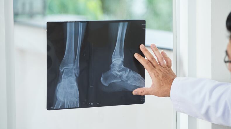 Bone strength is dependent upon a person's active lifestyle and eating habits. iSTOCK PHOTO/COX