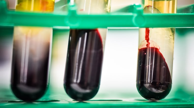 Testing of blood samples helps hospitals determine the presence of Hepatitis A. Butler County hospitals have seen a spike in Hepatitis A cases this year. NICK GRAHAM/STAFF