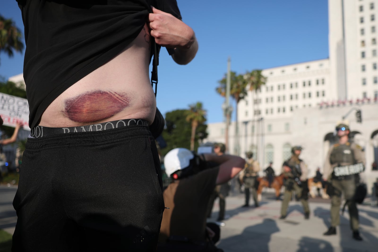 A protester displays their injury from a less-lethal round from several days ago during a protest outside City Hall on Wednesday, June 11, 2025, in Los Angeles. (AP Photo/Ethan Swope)