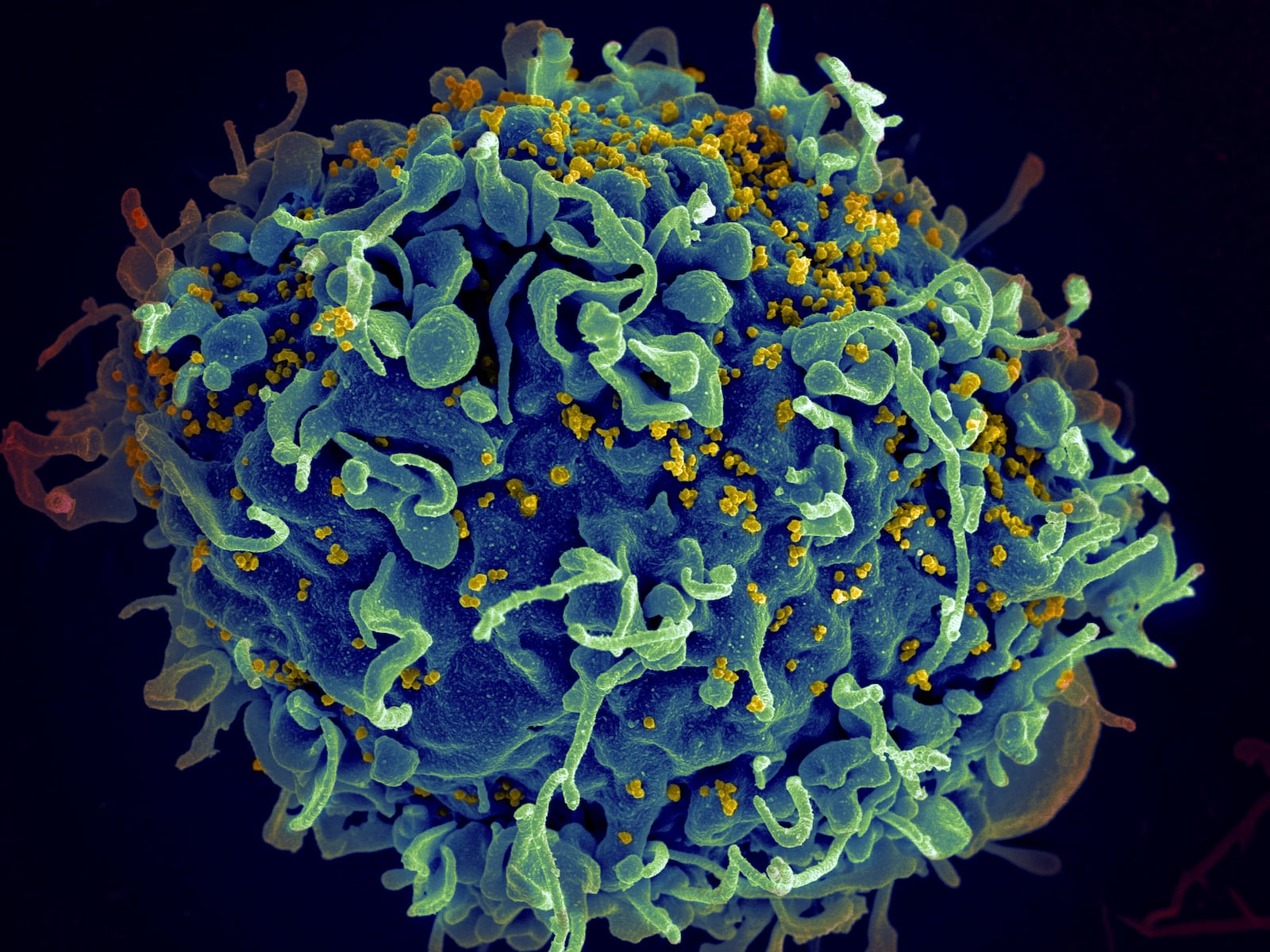 FILE - This colorized electron microscope image provided by the U.S. National Institutes of Health shows a human T cell, in blue, under attack by HIV, in yellow, the virus that causes AIDS. (Seth Pincus, Elizabeth Fischer, Austin Athman/National Institute of Allergy and Infectious Diseases/NIH via AP, File)