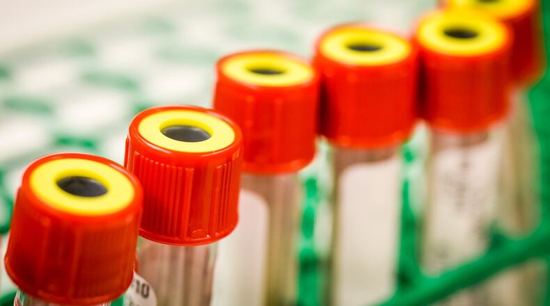 Testing of blood samples helps hospitals determine the presence of Hepatitis A. Butler County hospitals have seen a spike in Hepatitis A cases this year. NICK GRAHAM/STAFF