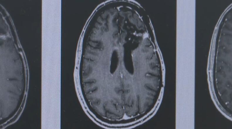 The University of Cincinnati is a study site for a new Phase 2b clinical trial testing a personalized immunotherapy approach to fighting glioblastoma (GBM). GBMs are fast-growing and aggressive brain tumors with only a 40% survival rate in the first year after diagnosis. WCPO/CONTRIBUTED