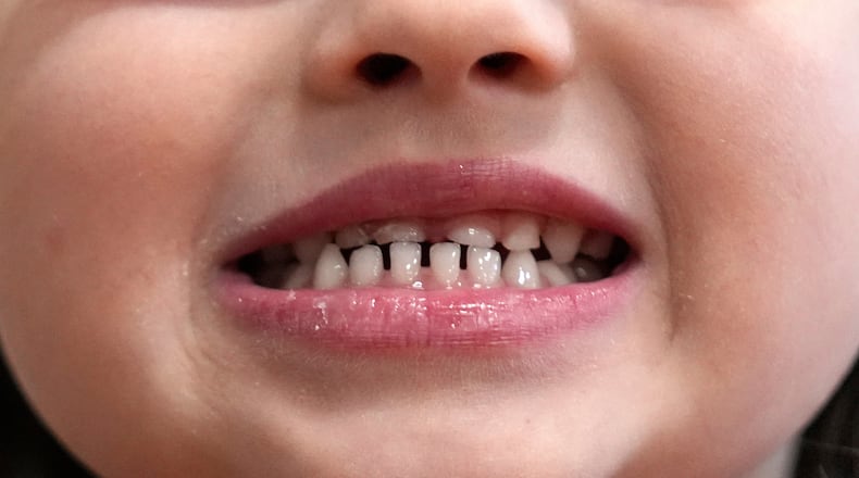 FILE - A child shows off her teeth after a dental exam in Concord, N.H., Wednesday, Feb. 21, 2024. (AP Photo/Robert F. Bukaty, file)