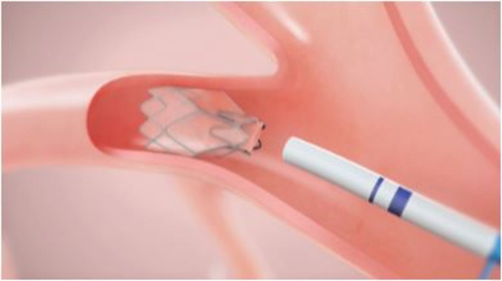 A Zephyr valve, which allows air to leave part of a lung but not enter it, is used as part of the procedure. PROVIDED