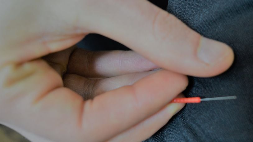Adam Gloyeske shows one of the needles he uses for his treatments. The needles are a half-inch to an inch long. CONTRIBUTED/BOB RATTERMAN